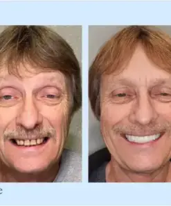 Hidone® 🦷Advanced Customized Full Denture Set🦷
