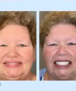 Hidone® 🦷Advanced Customized Full Denture Set🦷