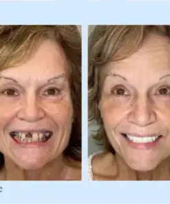 Hidone® 🦷Advanced Customized Full Denture Set🦷