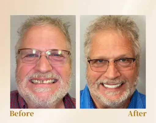 Hidone® --🦷Advanced Customized Full Denture Set🦷 (⏰Limited time discount last 30 minutes⏰)💎💎