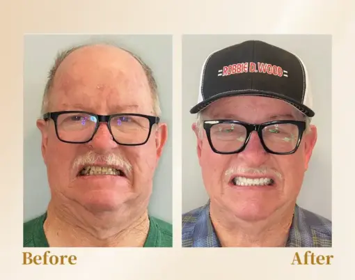 Hidone® --🦷Advanced Customized Full Denture Set🦷 (⏰Limited time discount last 30 minutes⏰)💎💎