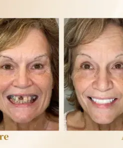 Hidone® --🦷Advanced Customized Full Denture Set🦷 (⏰Limited time discount last 30 minutes⏰)💎💎
