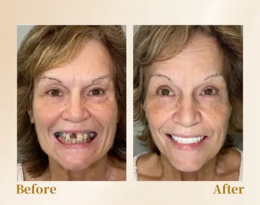 Hidone® --🦷Advanced Customized Full Denture Set🦷 (⏰Limited time discount last 30 minutes⏰)💎💎