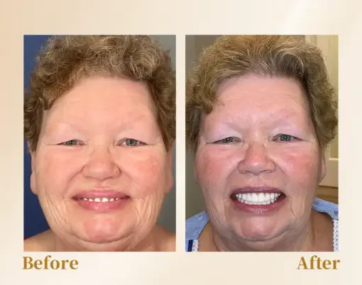Hidone® --🦷Advanced Customized Full Denture Set🦷 (⏰Limited time discount last 30 minutes⏰)💎💎