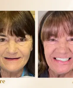 Hidone® --🦷Advanced Customized Full Denture Set🦷 (⏰Limited time discount last 30 minutes⏰)💎💎