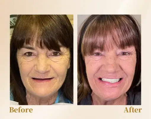 Hidone® --🦷Advanced Customized Full Denture Set🦷 (⏰Limited time discount last 30 minutes⏰)💎💎